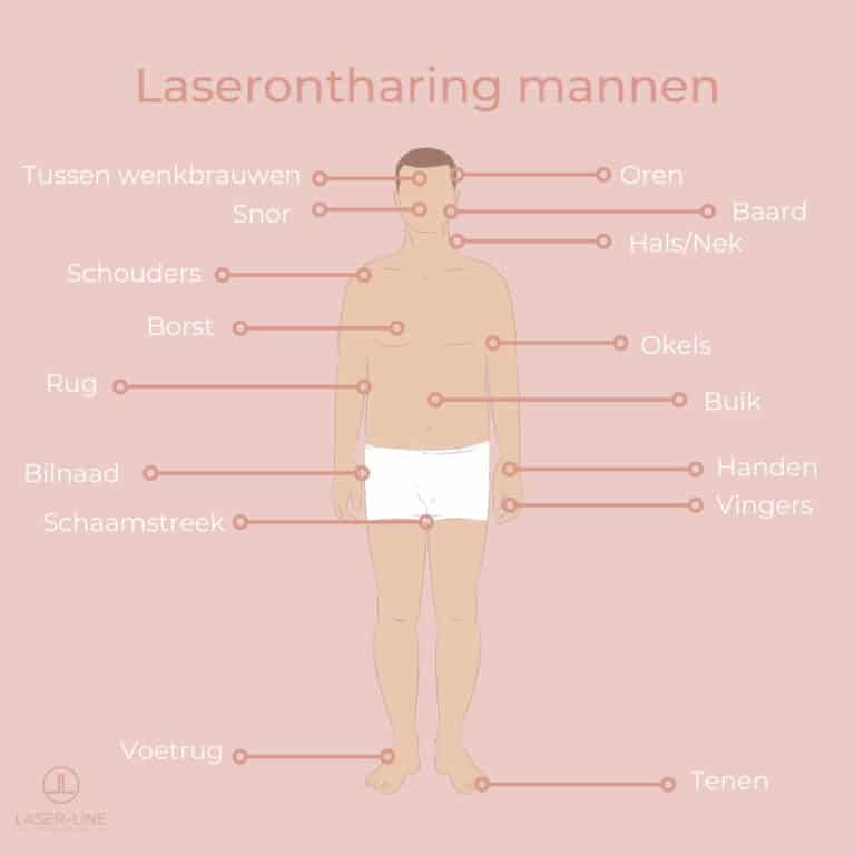 laserontharing mannen prijs laserbehandeling